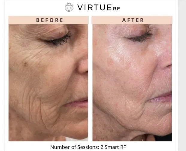 VIRTUE RF MICRONEEDLING