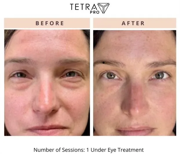 TETRA CO2 & COOL PEEL