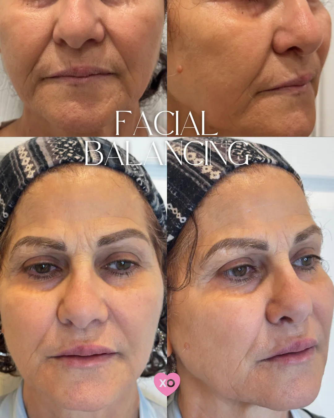 BEFOREAFTER - 10