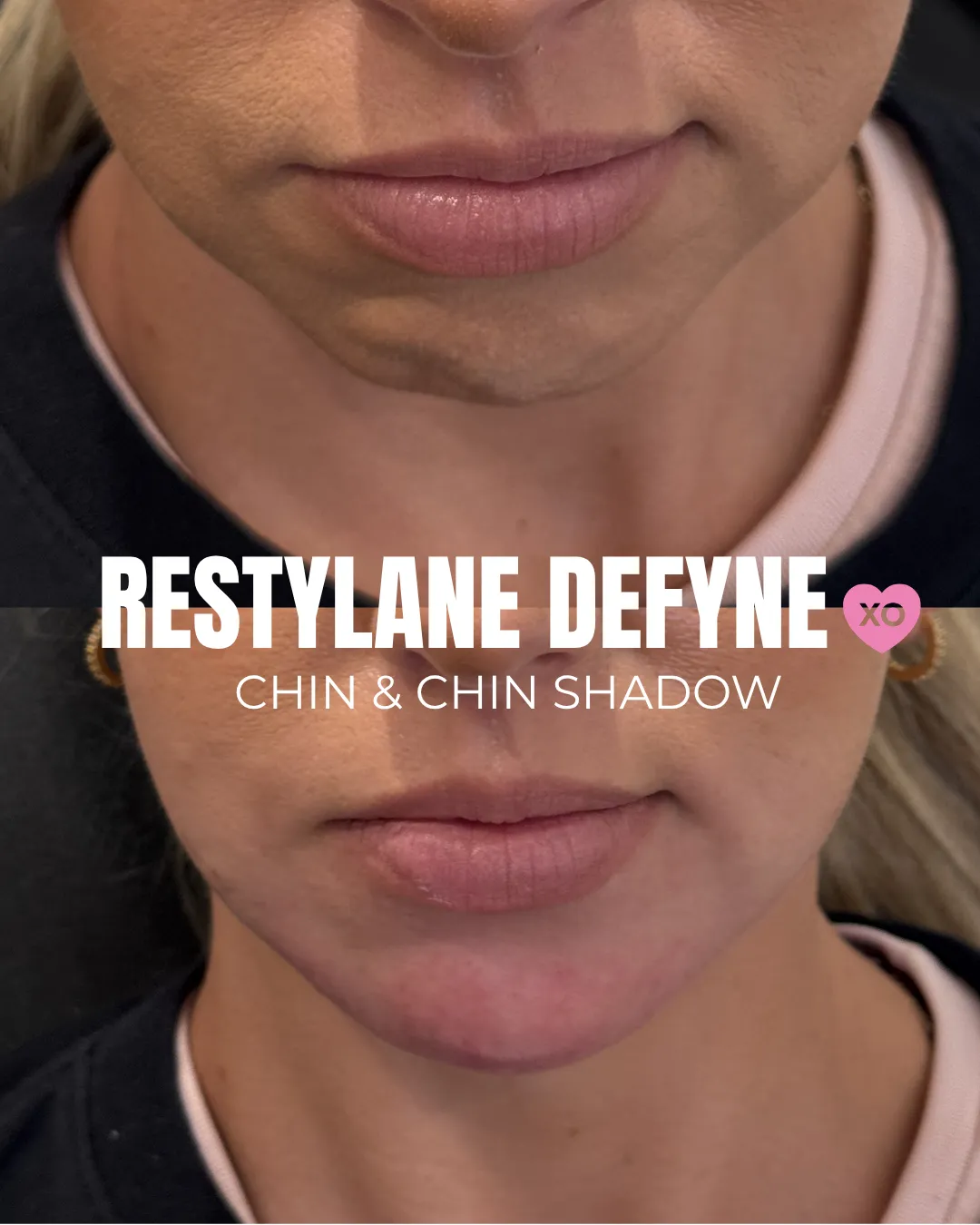 BEFOREAFTER - 23